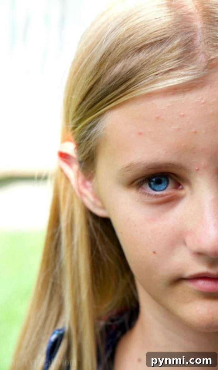 Teenage girl smiling, acne treatment on vacation