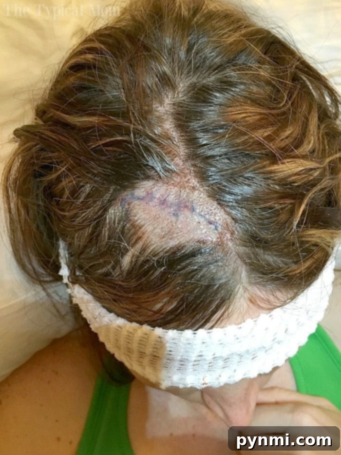 Mohs Surgery Pictures - Before and After Basal Cell Carcinoma Removal