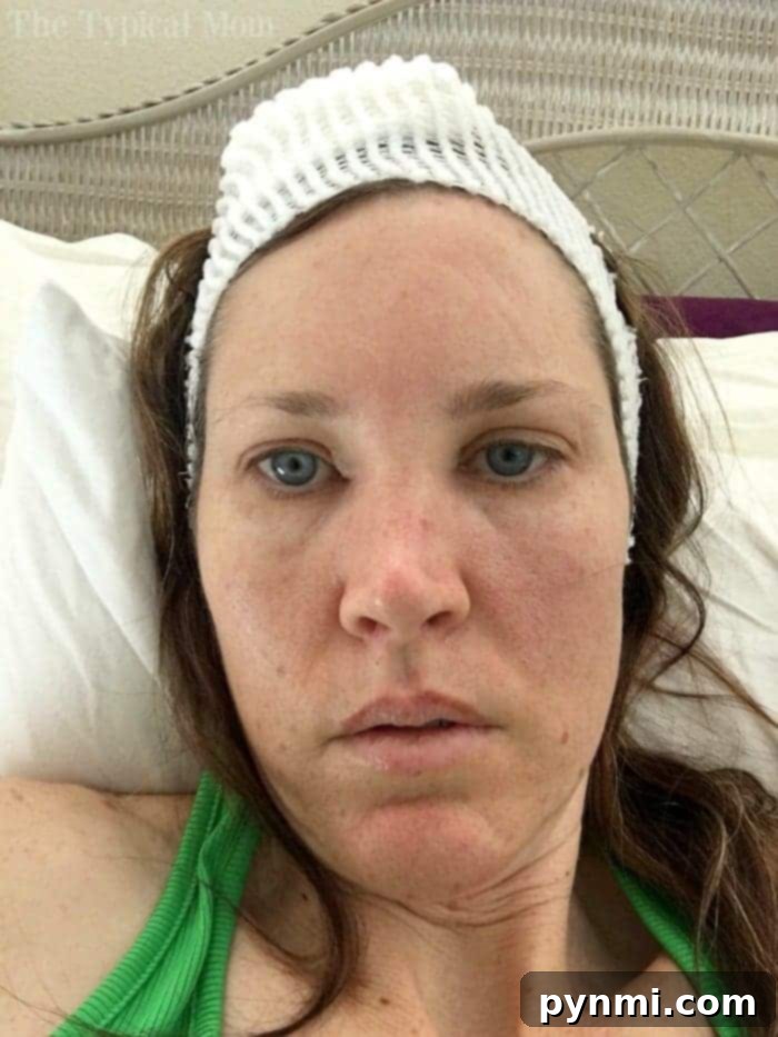 Mohs Surgery Scar Pictures - Healing Process